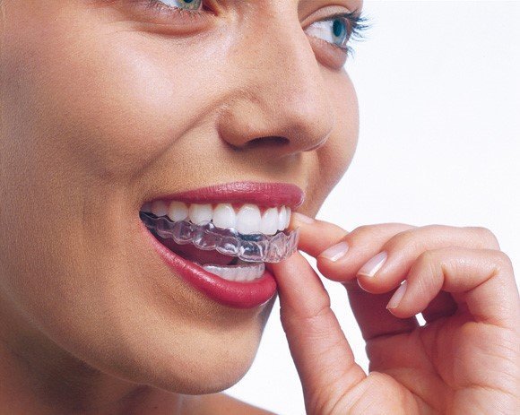 Invisalign Plymouth Dental Centre of Excellence