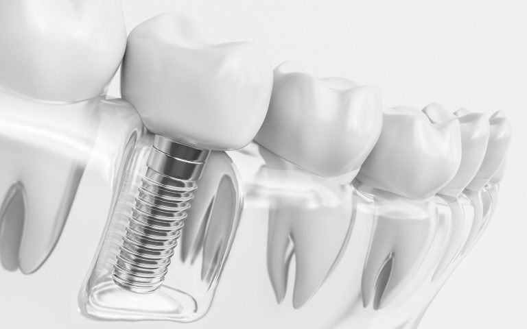 Dental Implant Plymouth